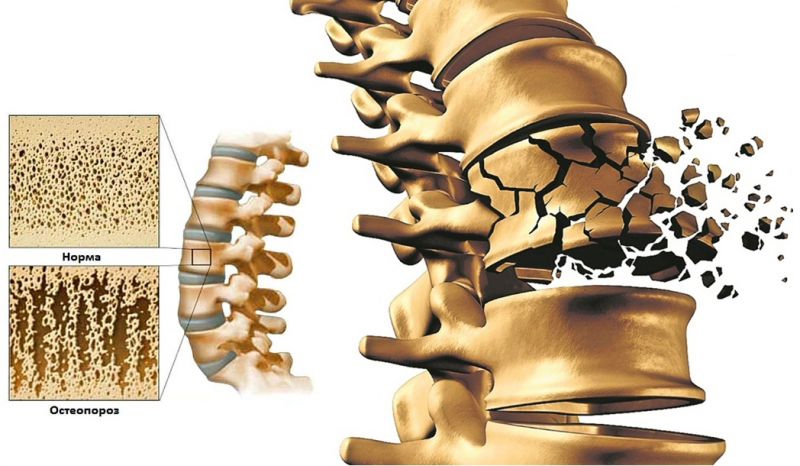 OSTEOPOROSIS