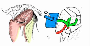 НЕСОСТОЯТЕЛЬНОСТЬ ШВОВ КУЛЬТИ ДВЕНАДЦАТИПЕРСТНОЙ КИШКИ В ХИРУРГИИ «ТРУДНЫХ» ДУОДЕНАЛЬНЫХ ЯЗВ: ВЫЗОВЫ И ПУТИ ИХ РЕШЕНИЯ