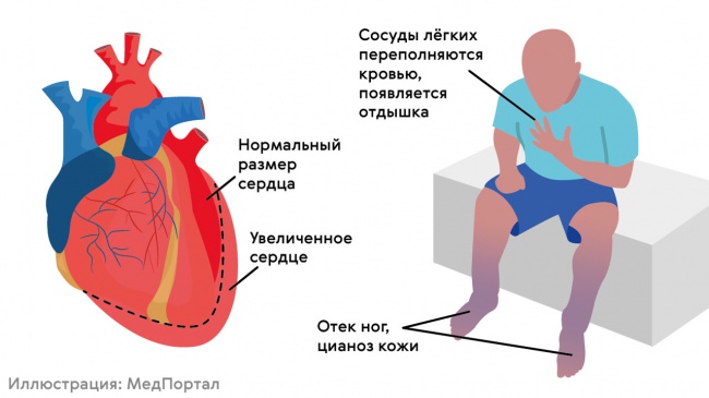 Блокады сердца