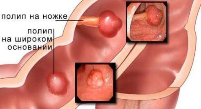 Аденоматозный полип прямой кишки - причины, симптомы и лечение
