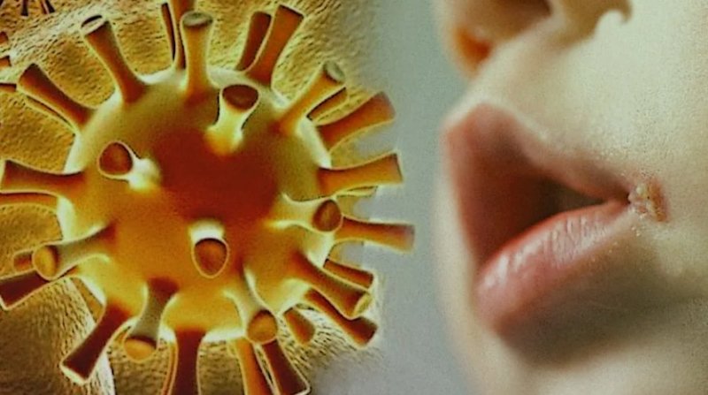 Что такое герпес и как избежать заражения им?