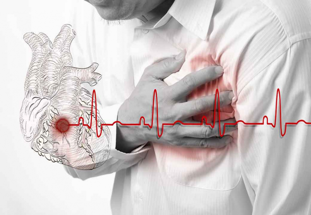 Профилактика Ишемическая болезнь сердца (ИБС)