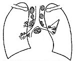 Tuberculosis of intrathoracic lymph nodes (Tuberculous bronchoadenitis)