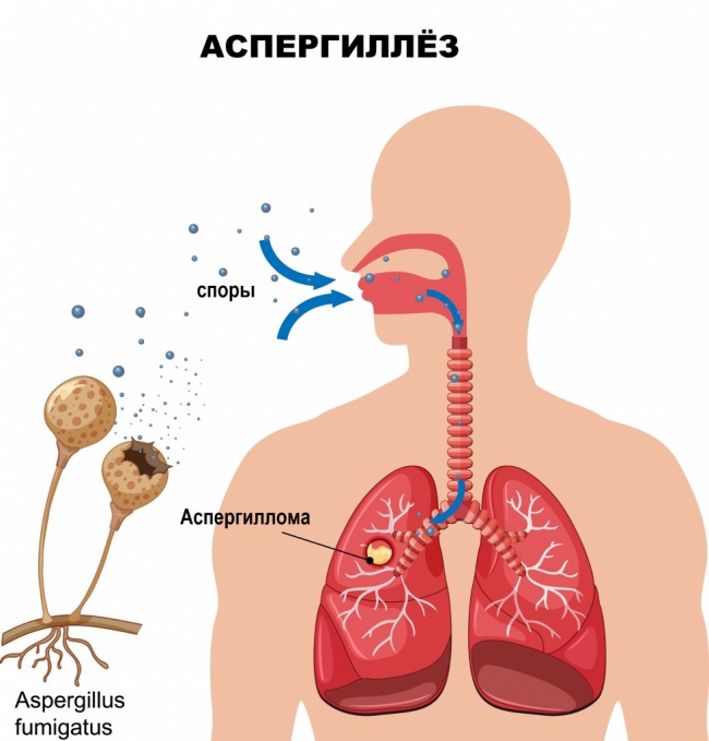 Аспергиллез