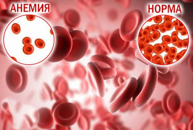 ЖЕЛЕЗОДЕФИЦИТНАЯ АНЕМИЯ У ПОДРОСТКОВ