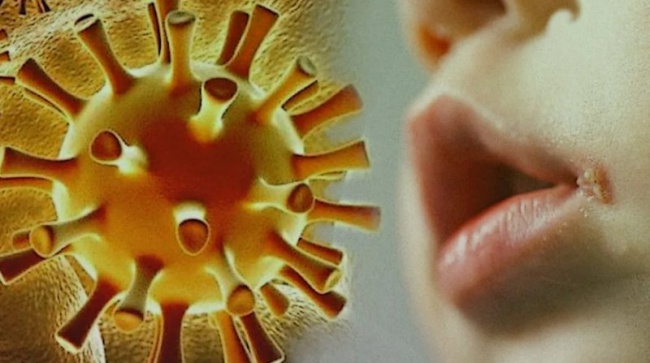 Что такое герпес и как избежать заражения им? Что такое герпес и как избежать заражения им?