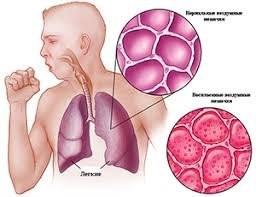 Specialist: « Pneumonia can be treated»