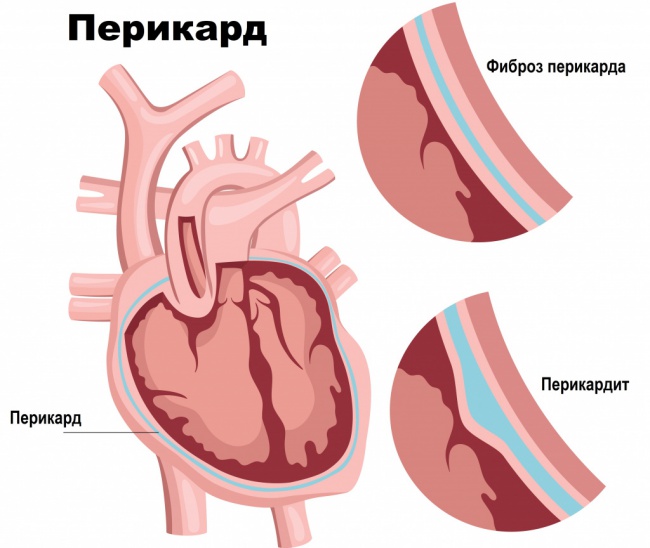 ГИДРОПЕРИКАРД: СИМПТОМЫ, ПРИЧИНЫ И МЕТОДЫ ЛЕЧЕНИЯ