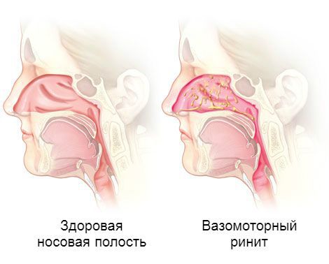 Аллергический ринит: симптомы, лечение, профилактика