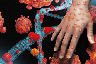 MONKEYPOX – AN INTERNATIONAL PROBLEM