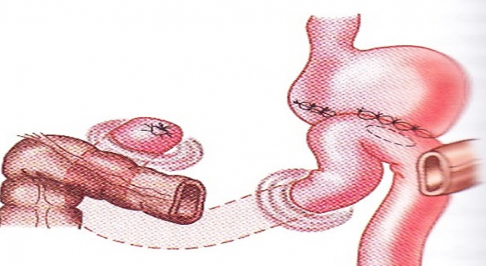 ПРОГНОСТИЧЕСКОЕ КРИТЕРИИ (ПРЕДИКТОРЫ) СЛОЖНОСТИ МОБИЛИЗАЦИИ ПИЛОРОДУОДЕНАЛЬНОЙ ЗОНЫ В ХИРУРГИЧЕСКОМ ЛЕЧЕНИИ  «ТРУДНЫХ» И «НЕУДАЛИМЫХ» СТЕНОЗИРУЮЩИХ ЯЗВ 12 КИШКИ