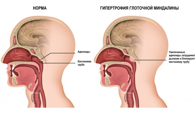 Аденоиды